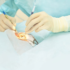 Ophthalmology laser microscope operation. Doctor in clinic. Patient eye treatment. Myopia and...