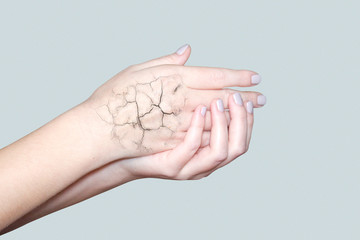 Hand with cracked skin. Cracked skin, dry skin. Skin care in winter, moisturizing the skin