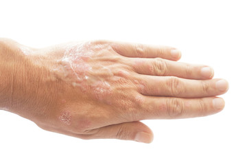 Psoriasis vulgaris and fungus on the man hand with plaque, rash and patches on the skin, isolated on white background. Autoimmune genetic disease.