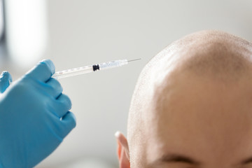 medicine, mesotherapy and cosmetic surgery concept - close up of cosmetologist's or doctors's hands with syringe making injection of hair growth serum to bald male head skin