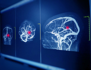 MRA AND MRV OF BRAIN  Finding:Bilateral territorial muscles to the cortex and subcortical of the parietal and low hemispheres cerebellar.