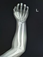Fracture radius image x-ray.Medical image concept.