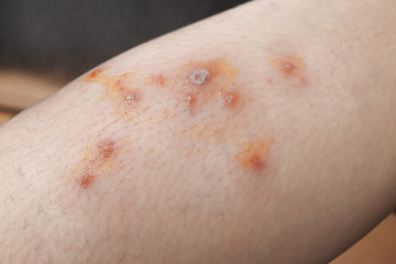 Blisters  Purulent wounds  Inflammation  Allergic on the skin leg of women Caused by the poison of insects painful And scarring close up