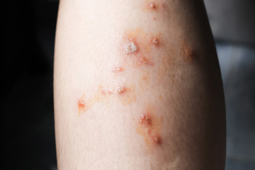 Blisters  Purulent wounds  Inflammation  Allergic on the skin leg of women Caused by the poison of insects painful And scarring close up
