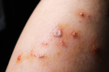 Blisters  Purulent wounds  Inflammation  Allergic on the skin leg of women Caused by the poison of...