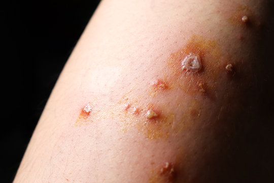 Blisters  Purulent wounds  Inflammation  Allergic on the skin leg of women Caused by the poison of insects painful And scarring close up