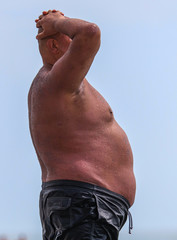 A fat man burned in the sun