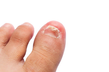 The left toe has been injured in an accident Is a swelling  redness inflammation The bones were...