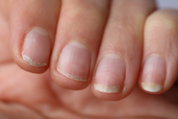 Damaged nails after gel polish. Close up.