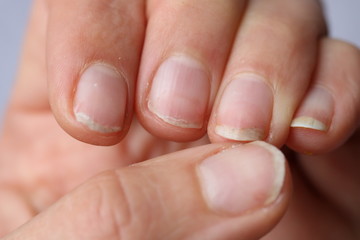 Damaged nails after gel polish. Close up. - obrazy, fototapety, plakaty