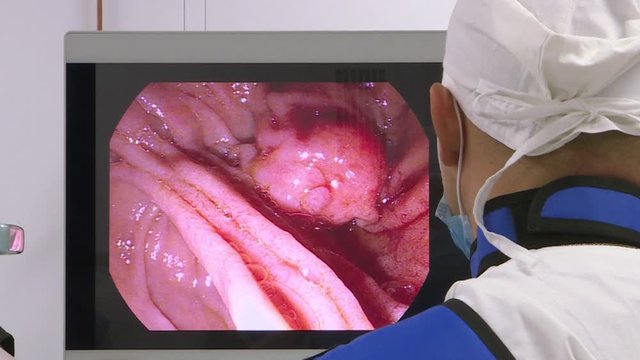Doctors use medical instruments and video cameras to perform abdominal surgery .
