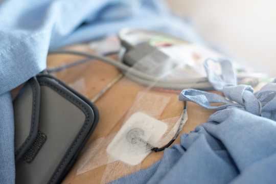 Twenty-four hour Holter monitor on chest and stomach of patient for doctor to test and record heart's rate and rhythm for 24 hours in hosptial.