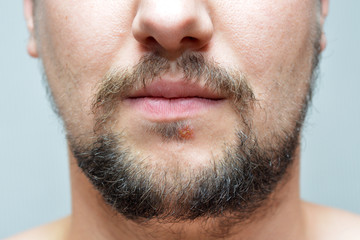 Fototapeta premium Lower part of beard man's face with herpes. Herpes infection on the skin. Medical care photo.