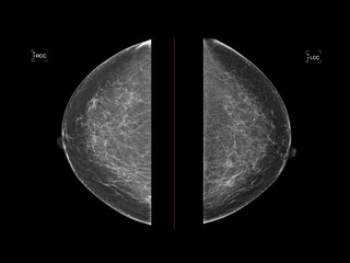 Mammogram or Mammography show normal healthy human breast. Mammogram used in diagnosis, screening for early detection of breast cancer. Medical technology investigation and imaging concept