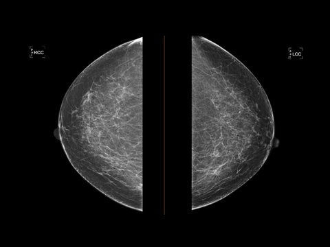 Mammogram or Mammography&nbsp;show normal healthy human&nbsp;breast. Mammogram used in diagnosis, screening for early detection of&nbsp;breast cancer. Medical technology investigation and imaging concept