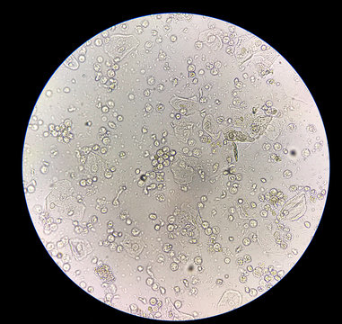 Moderate bacteria and white blood cells in patien bacteria urinary tract infection.