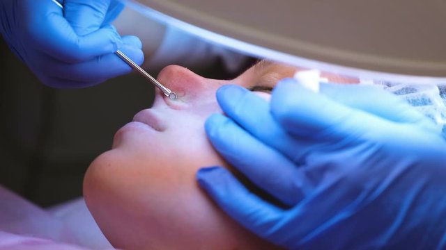 Mechanical cleaning of the face at the beautician. Cosmetologist squeeze the acne on the nose of the patient with medical needle