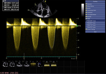 Screen of echocardiography (ultrasound) machine.