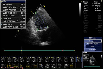 Screen of echocardiography (ultrasound) machine.
