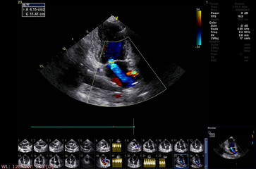 Screen of echocardiography (ultrasound) machine.