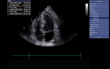 Screen of echocardiography (ultrasound) machine.