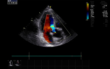 Screen of echocardiography (ultrasound) machine.