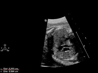 Ultrasound examination of the fetal heart.