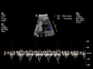 Ultrasound examination of the fetal heart.