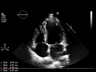 Screen of echocardiography (ultrasound) machine.