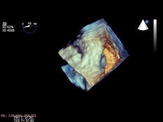 Modern 3D echocardiography.