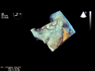 Modern 3D echocardiography.