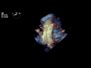 Modern 3D echocardiography.