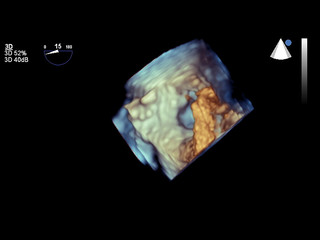 Modern 3D echocardiography.