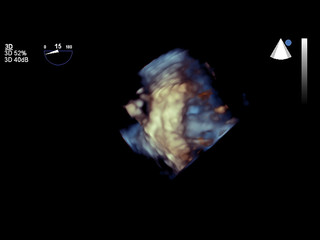 Modern 3D echocardiography.