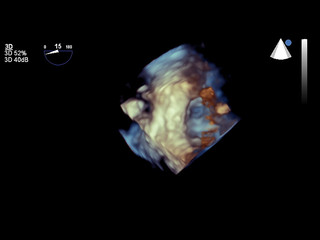 Modern 3D echocardiography.