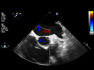 Screen of echocardiography (ultrasound) machine.