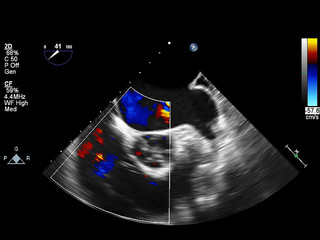 Screen of echocardiography (ultrasound) machine.