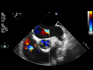Screen of echocardiography (ultrasound) machine.