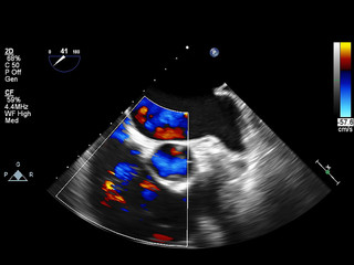 Screen of echocardiography (ultrasound) machine.
