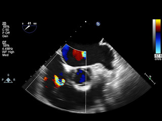 Screen of echocardiography (ultrasound) machine.