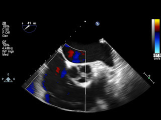 Screen of echocardiography (ultrasound) machine.