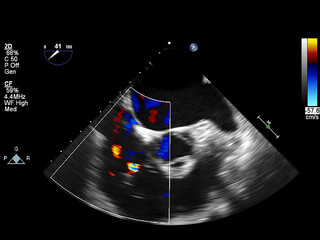 Screen of echocardiography (ultrasound) machine.