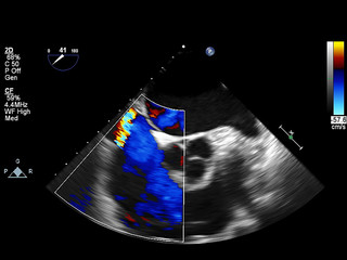 Screen of echocardiography (ultrasound) machine.