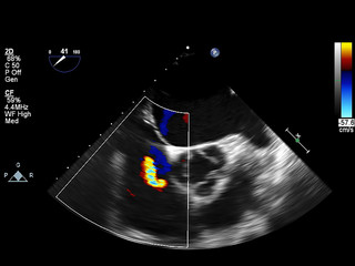 Screen of echocardiography (ultrasound) machine.