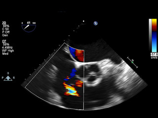 Screen of echocardiography (ultrasound) machine.