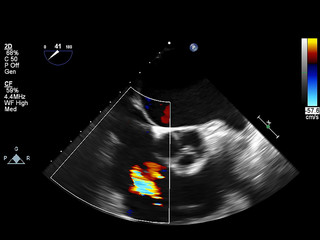 Screen of echocardiography (ultrasound) machine.