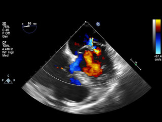 Screen of echocardiography (ultrasound) machine.