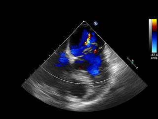 Screen of echocardiography (ultrasound) machine.