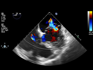 Screen of echocardiography (ultrasound) machine.