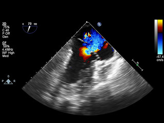 Screen of echocardiography (ultrasound) machine.
